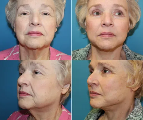 Results preview for facelift
