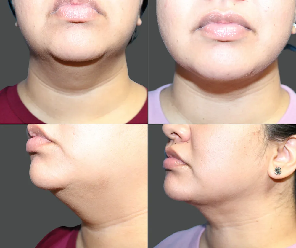 Neck Liposuction Before & After result 4