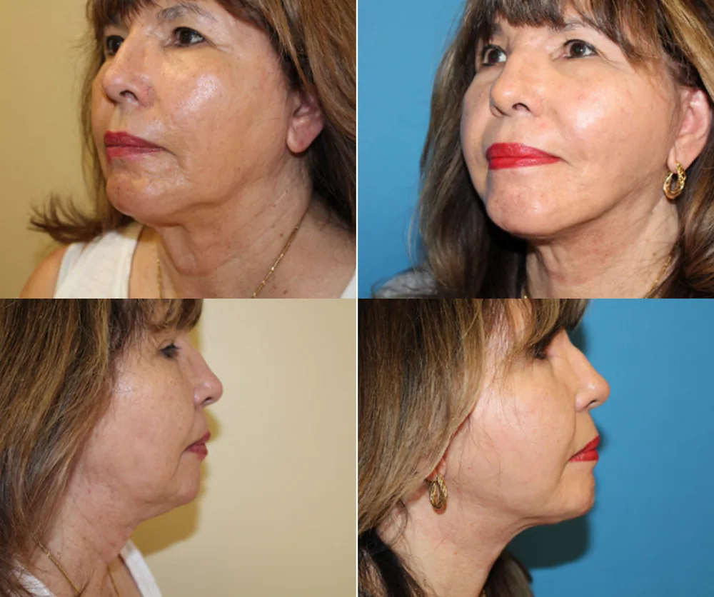 FACE LIFT BEFORE & AFTER result 7
