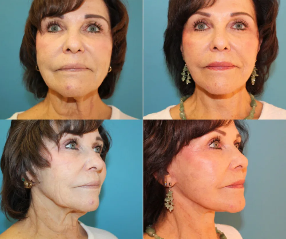 FACE LIFT BEFORE & AFTER result 6