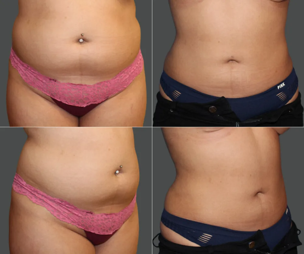 Liposuction before-and-after result 2