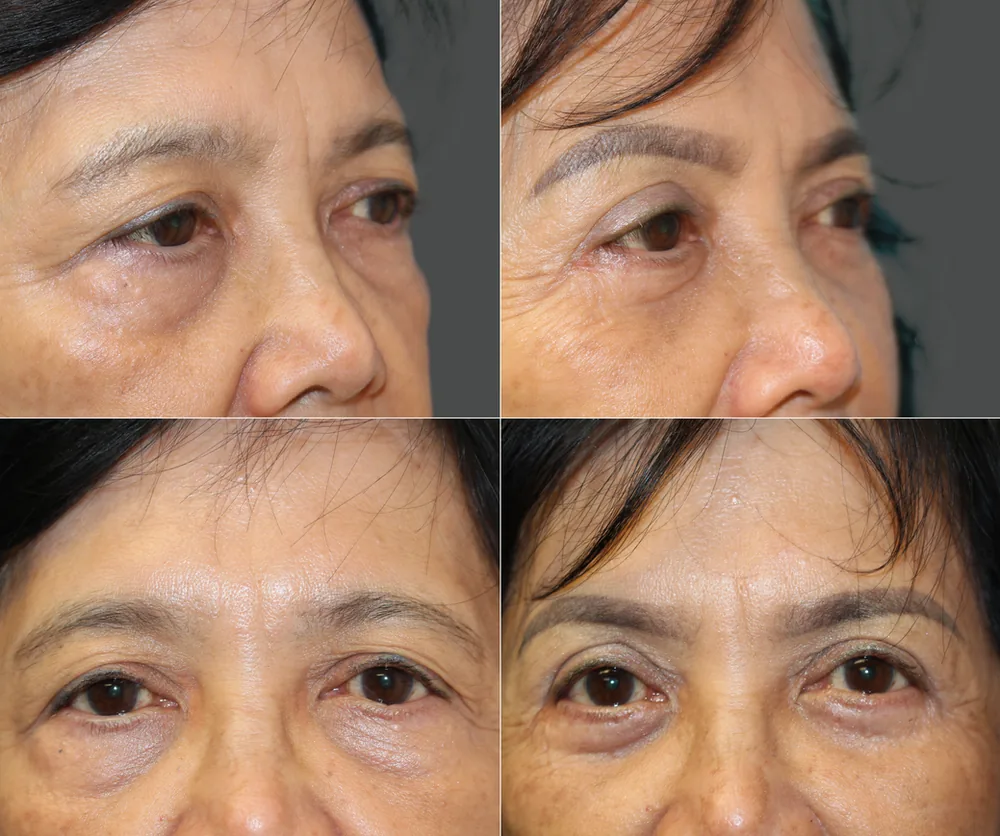 Eyelid Surgery Before & After result 9
