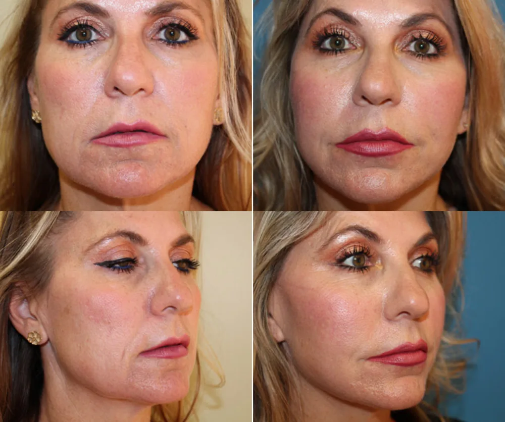 FACELIFT before-and-after result 2