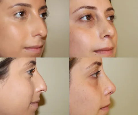 Results preview for rhinoplasty