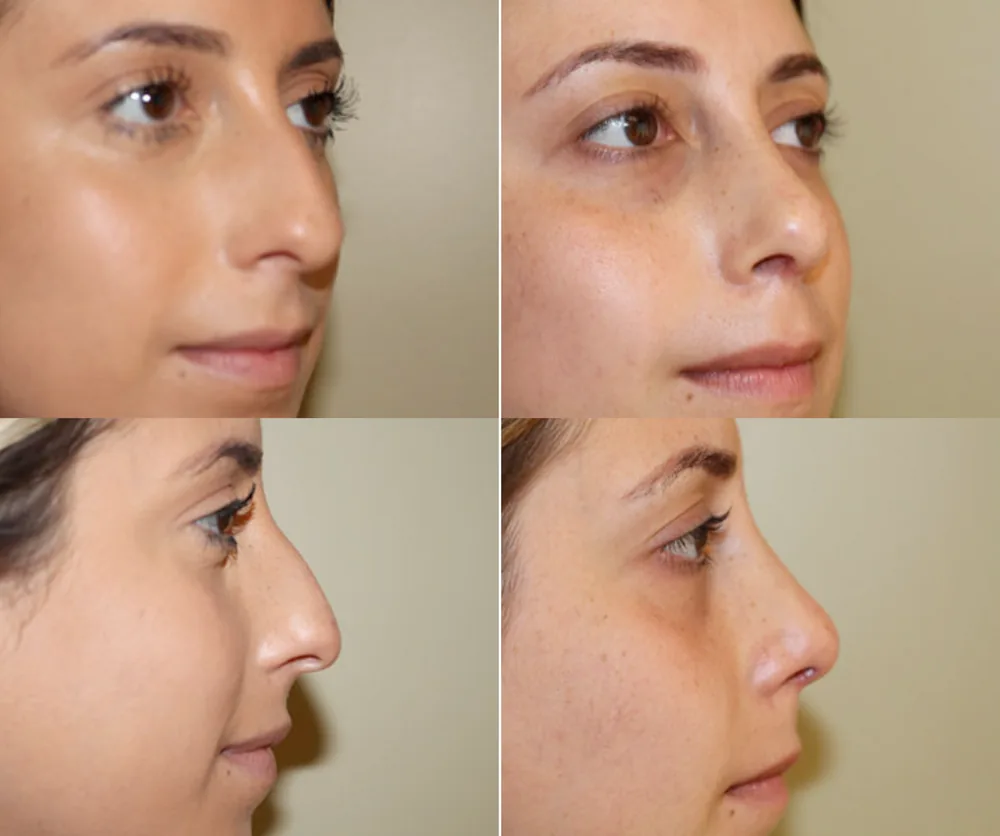 RHINOPLASTY before-and-after result 1