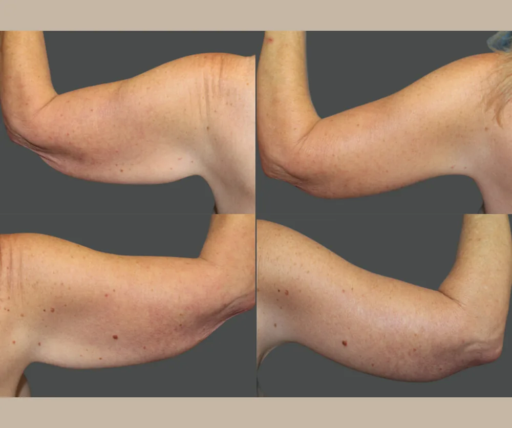 Arm Lift before-and-after result 3