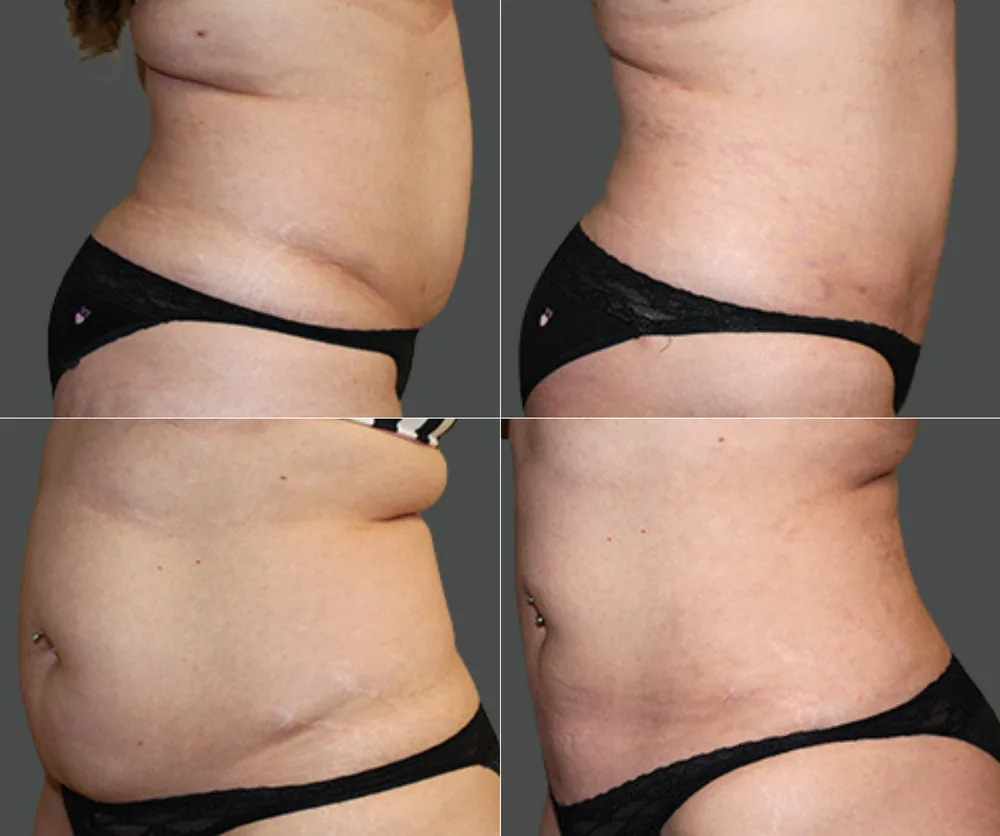 Liposuction Before & After result 5