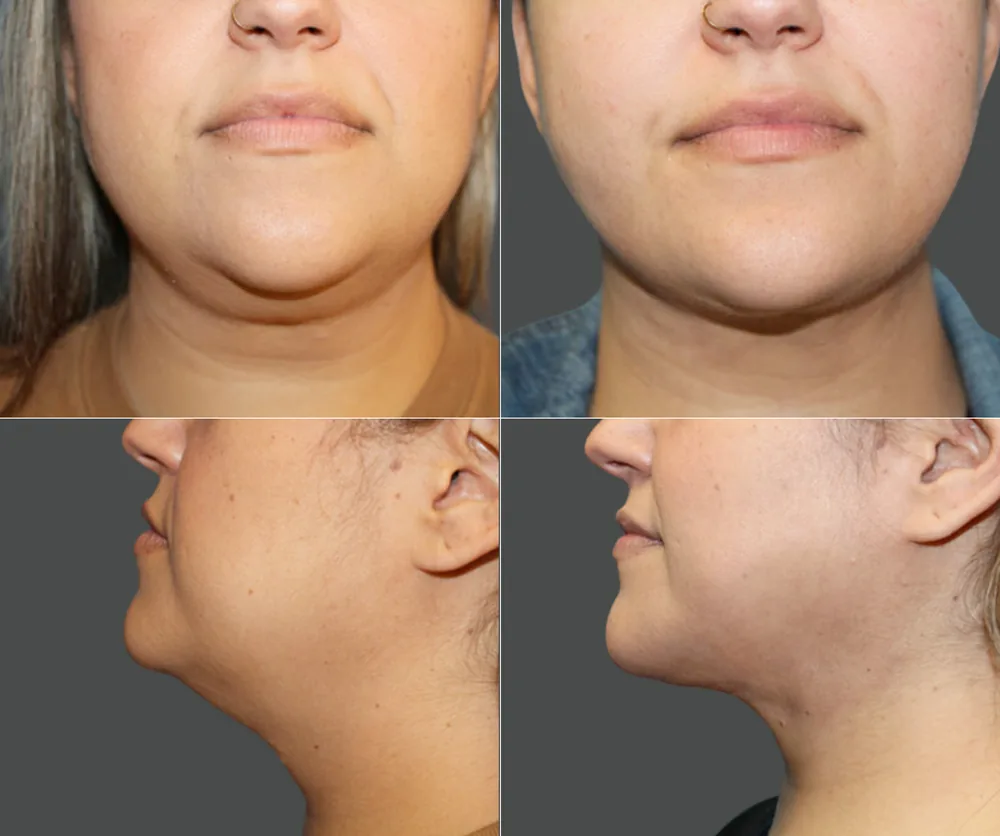 CHIN LIPOSUCTION before-and-after result 2