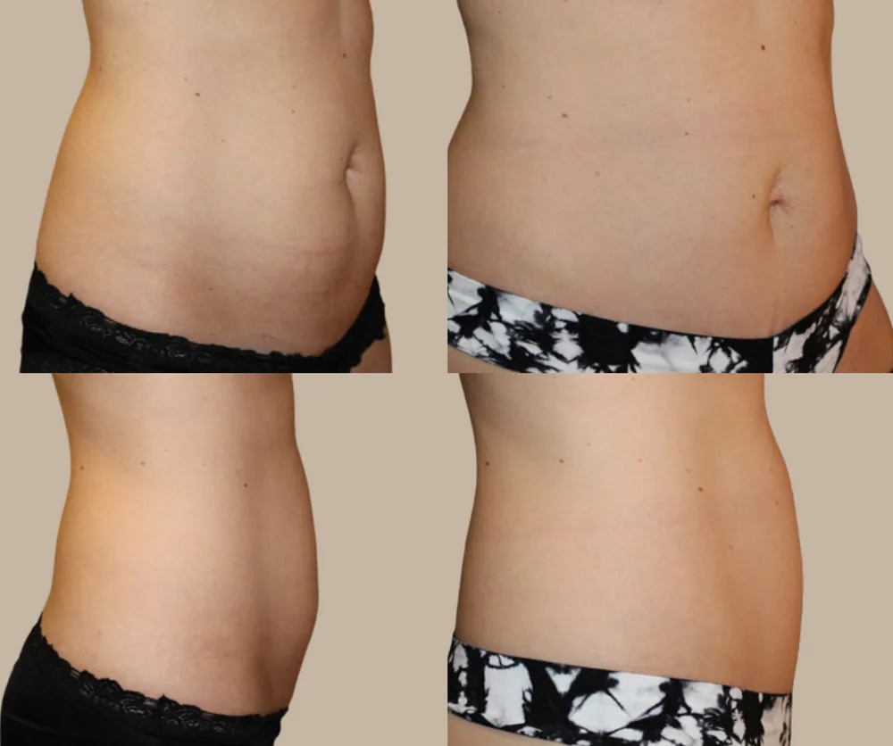 Mini Tummy Tuck Before & After result 2