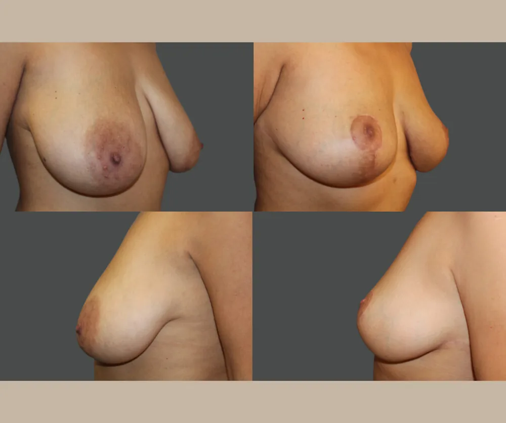 BREAST LIFT before-and-after result 3