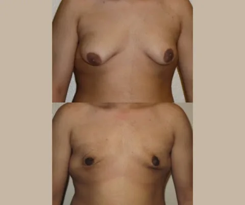 Results preview for male breast reduction