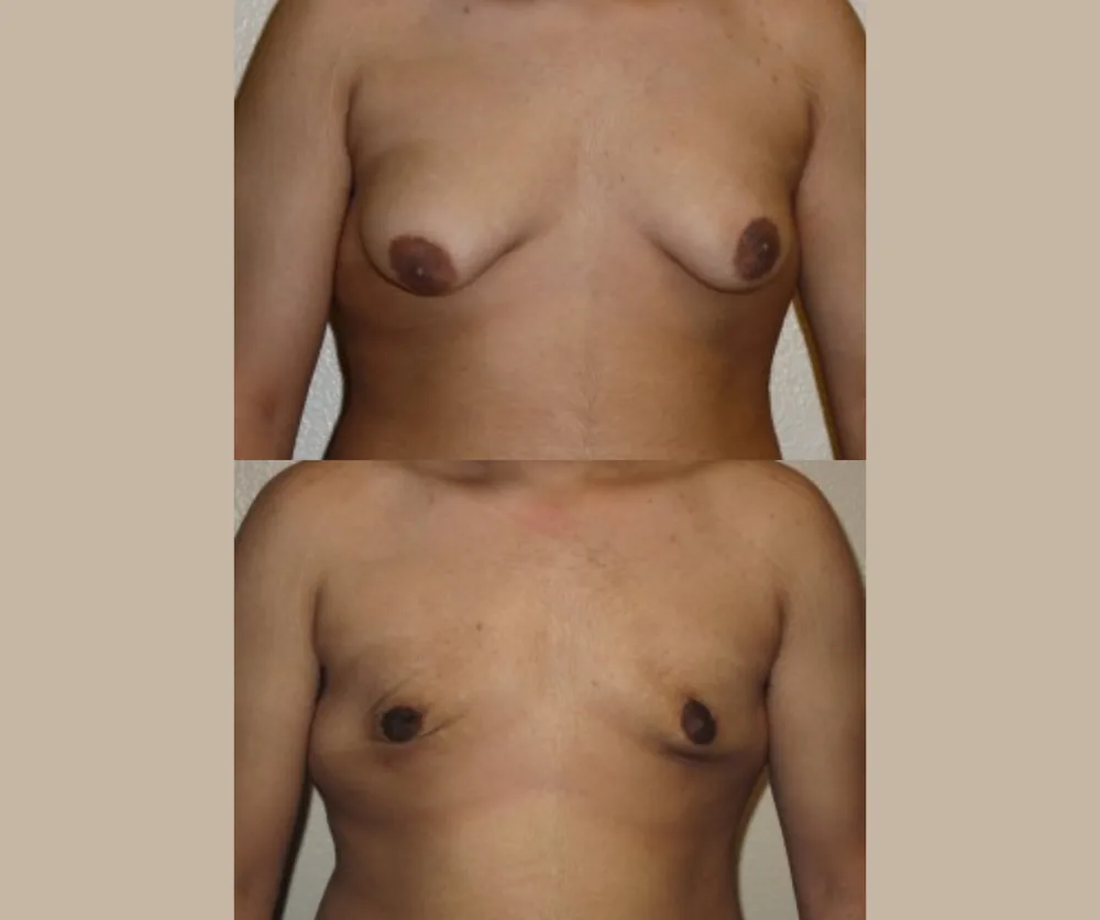 MALE BREAST REDUCTION before-and-after result 1