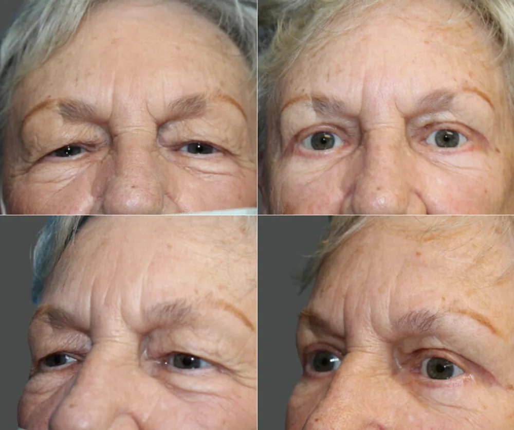 EYELID SURGERY before-and-after result 3