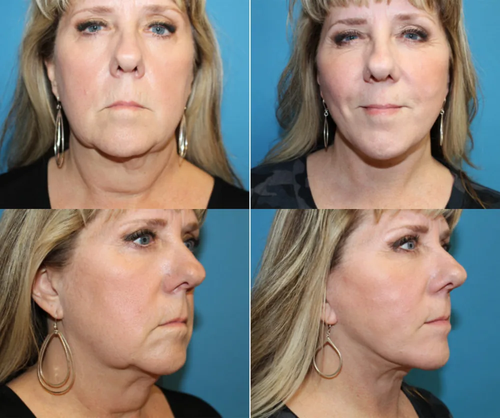 FACELIFT before-and-after result 3
