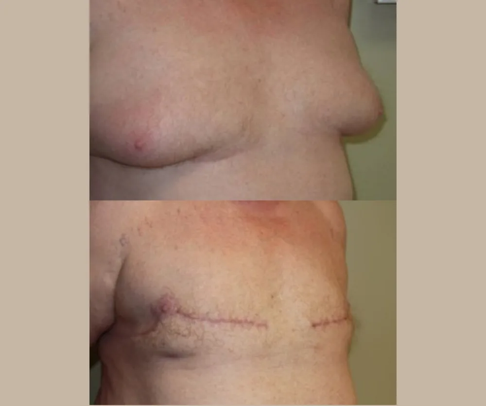 MALE BREAST REDUCTION before-and-after result 3