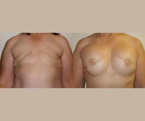 Results preview for breast reconstruction