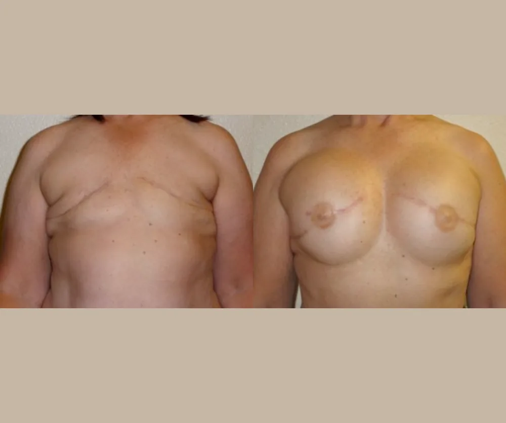 BREAST RECONSTRUCTION before-and-after result 1