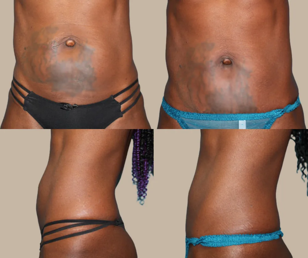Mini Tummy Tuck Before & After result 3