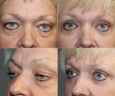 Results preview for eyelids