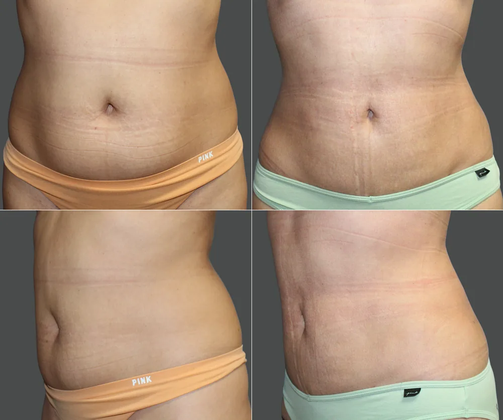 Liposuction Before & After result 8