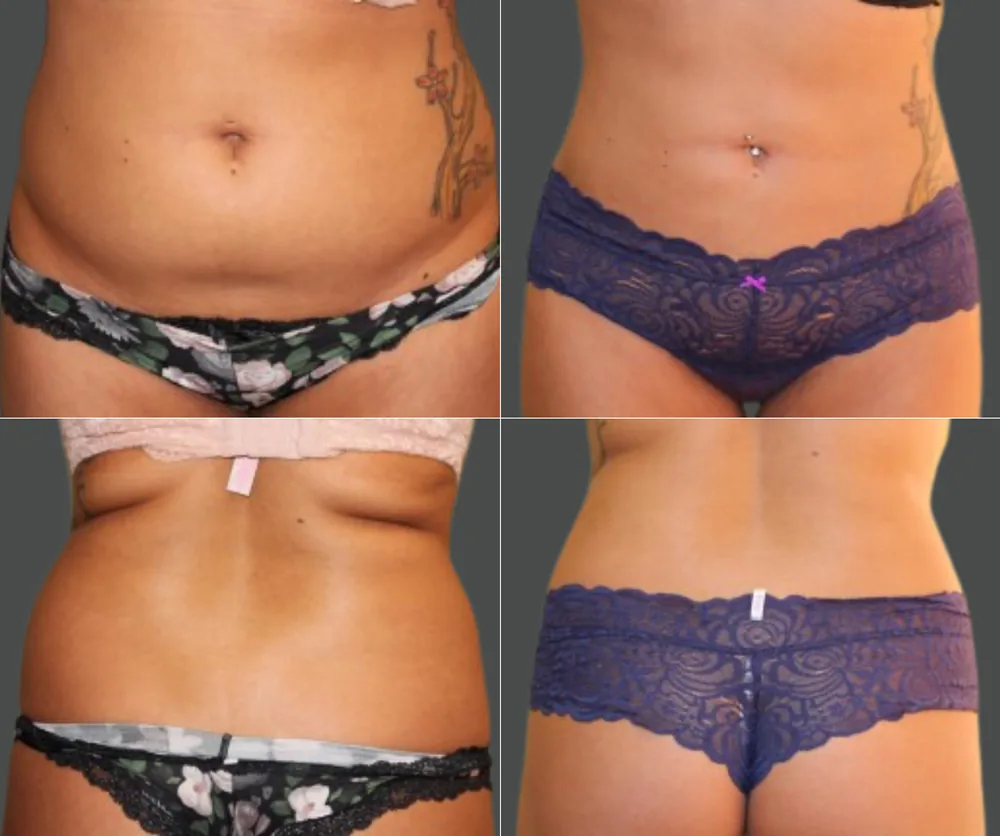Liposuction Before & After result 4