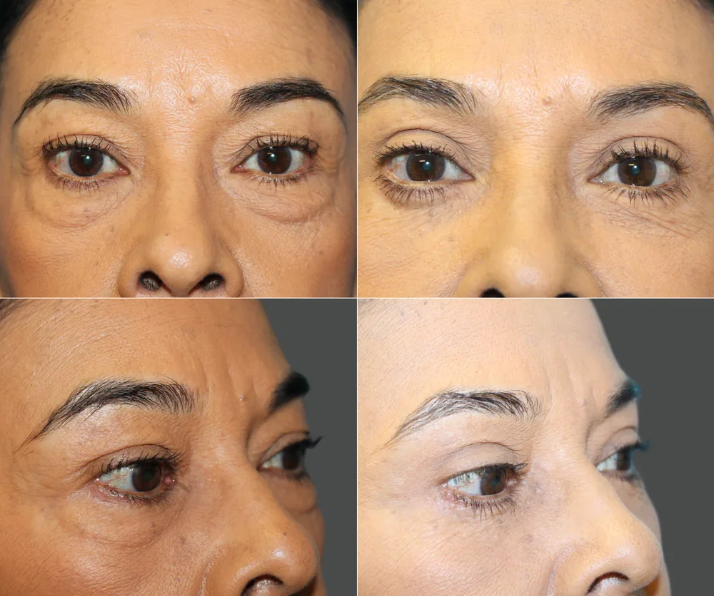 Eyelid Surgery Before & After result 10