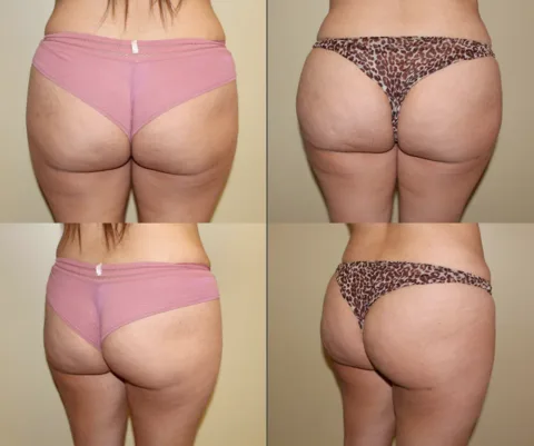 Results preview for brazilian butt lift