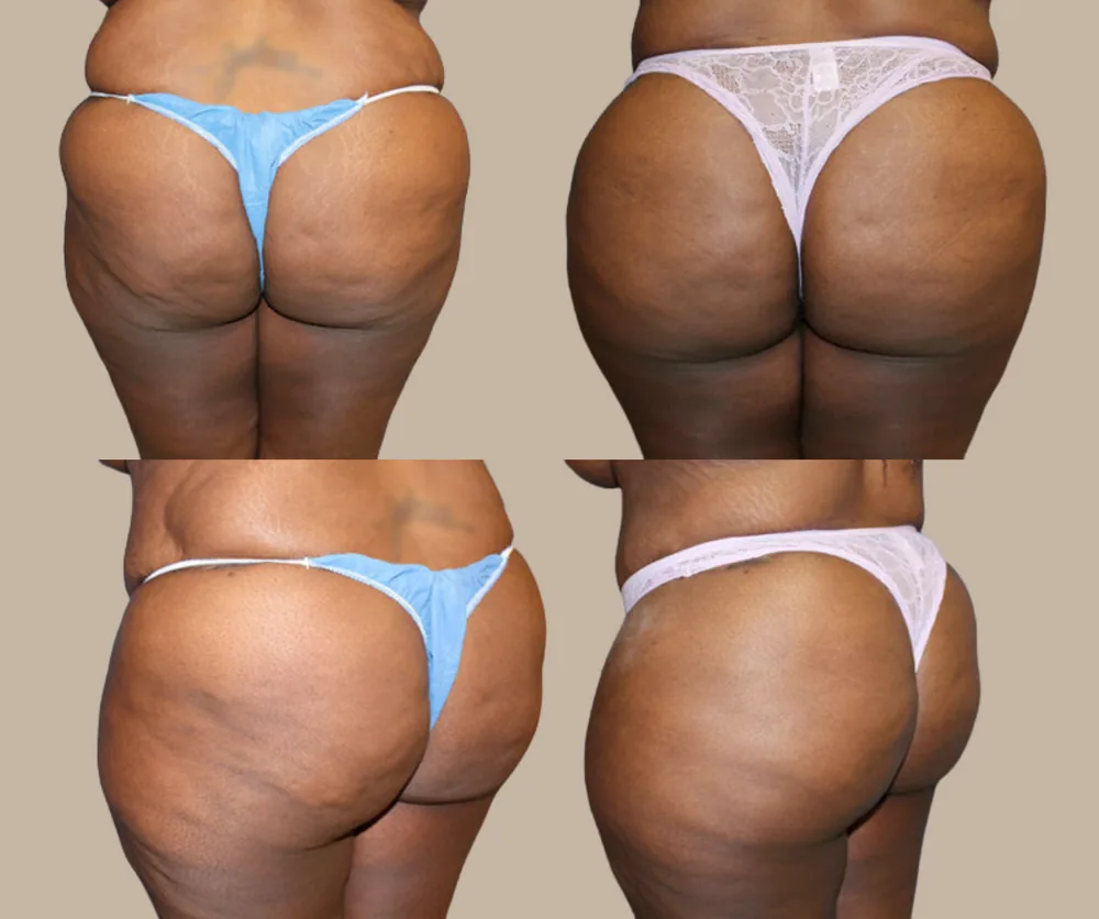 Brazilian Butt Lift Before & After result 5