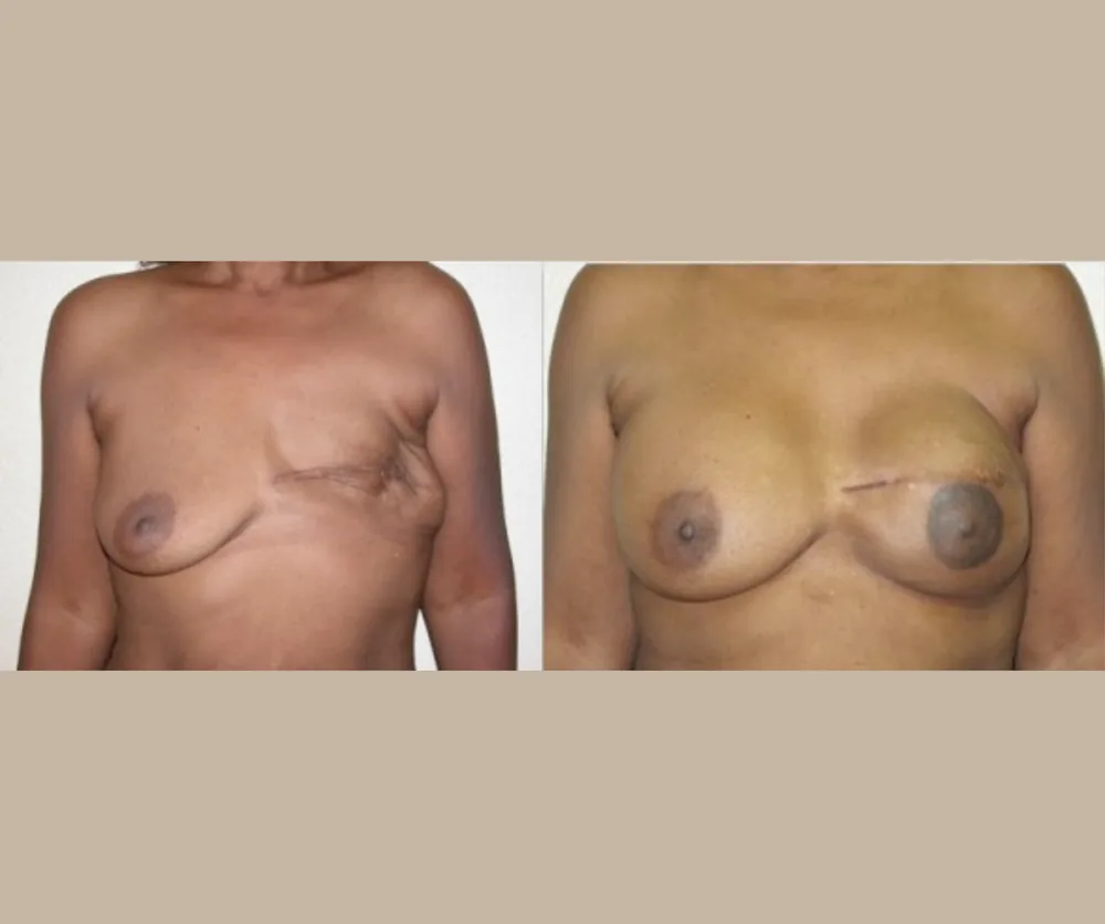 BREAST RECONSTRUCTION before-and-after result 3