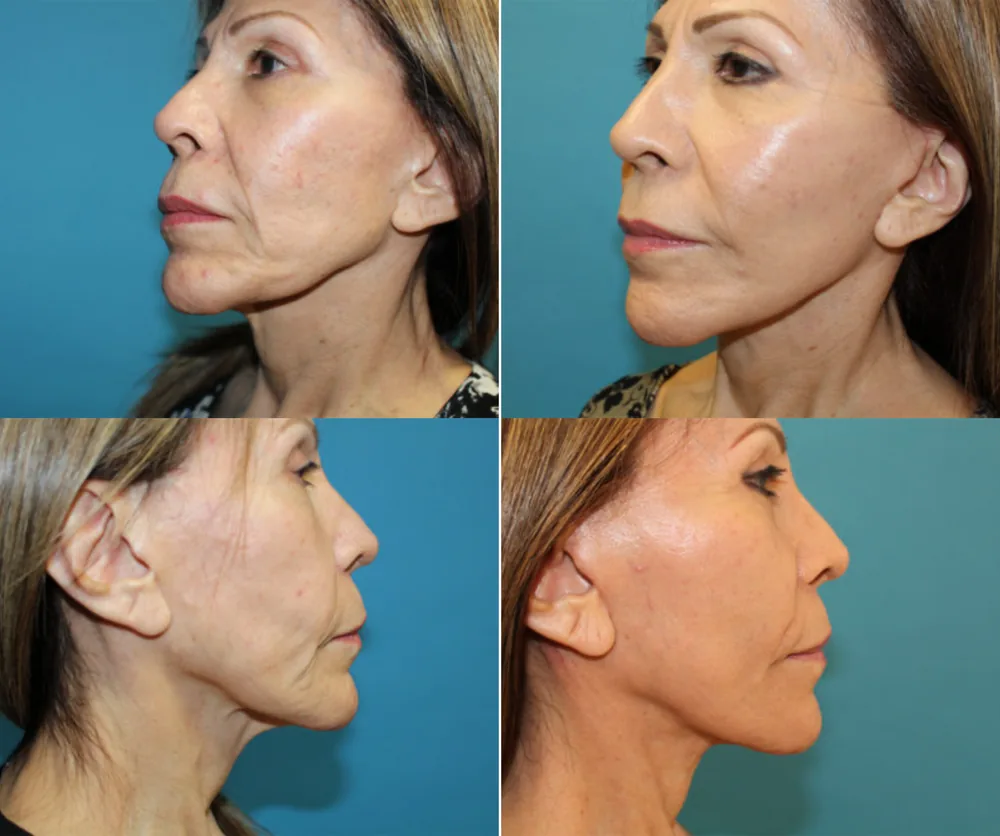 FACE LIFT BEFORE & AFTER result 5