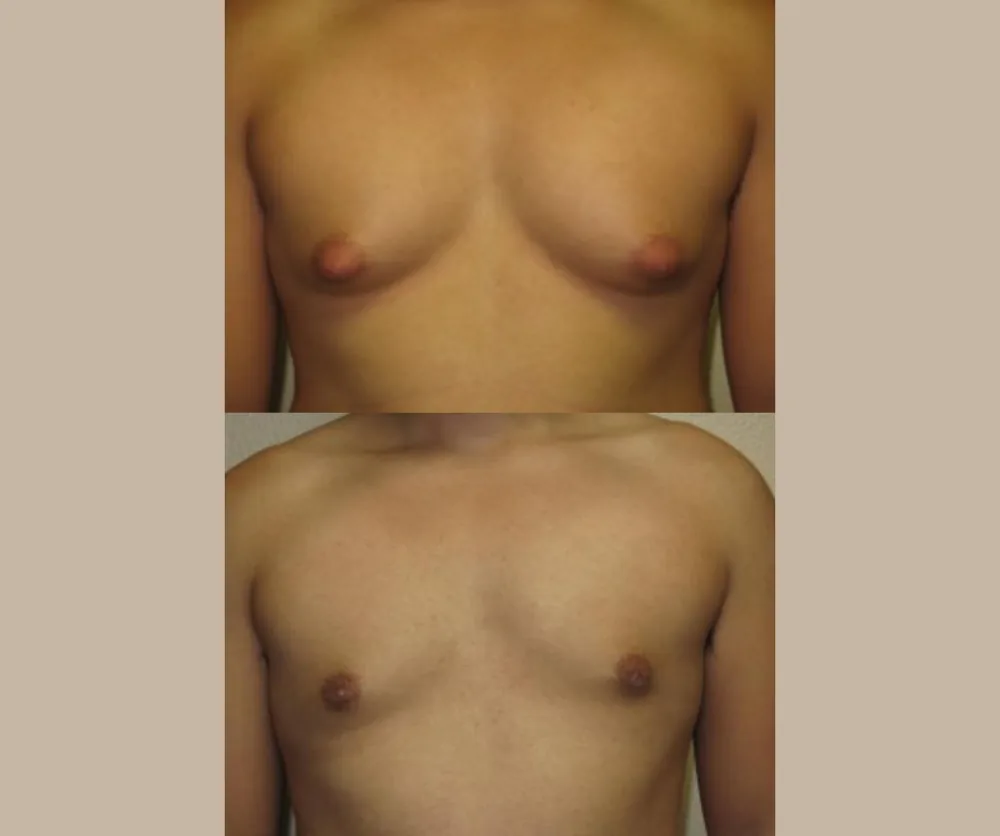 Male Breast Reduction Before & After result 4