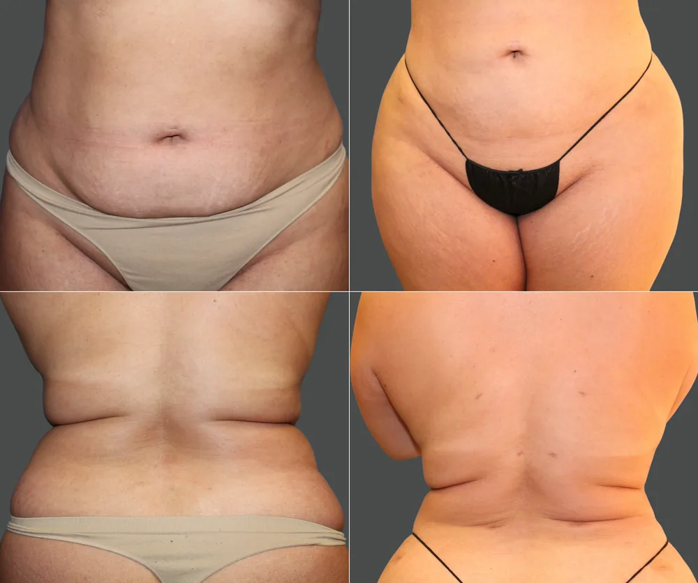 Liposuction Before & After result 7