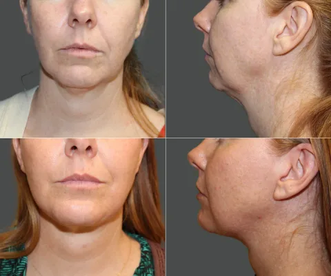 Results preview for chin implant
