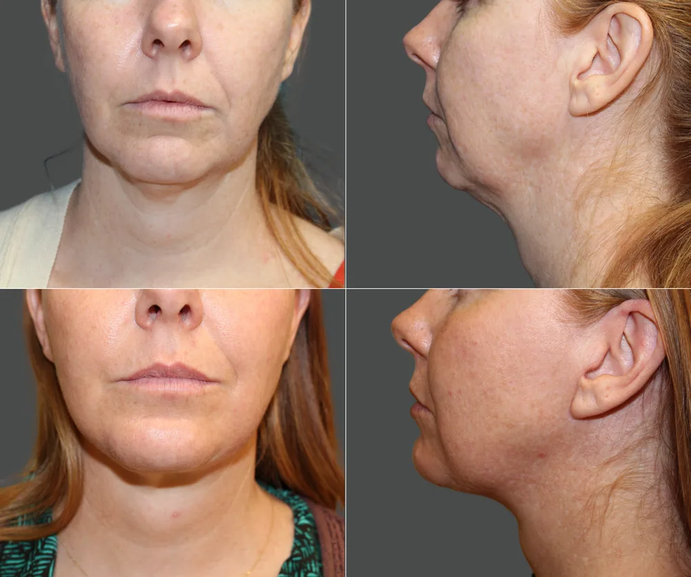 CHIN IMPLANT before-and-after result 1