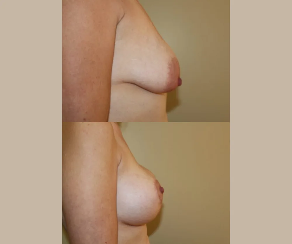 Breast Augmentation with Lift Before & After result 8