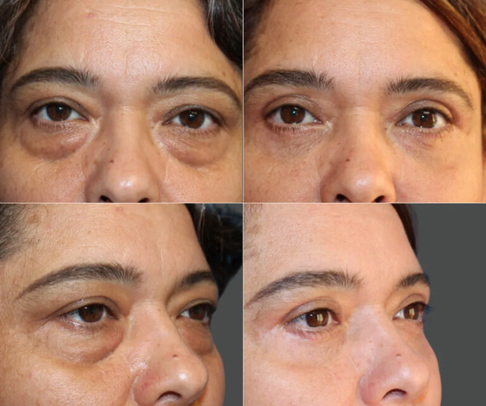 Eyelid Surgery Before & After result 7