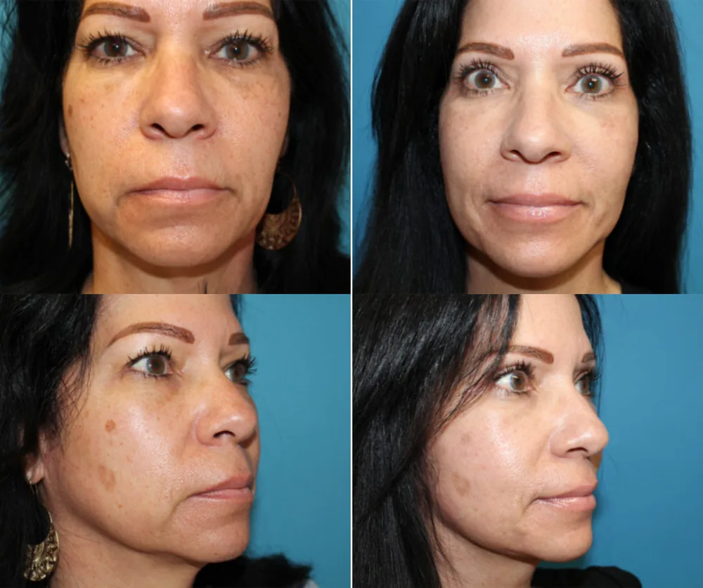 FACE LIFT BEFORE & AFTER result 4