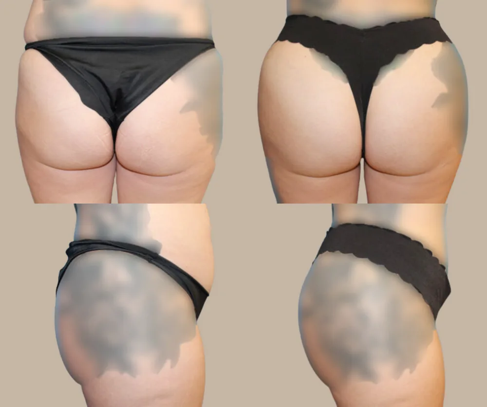 Brazilian Butt Lift before-and-after result 2