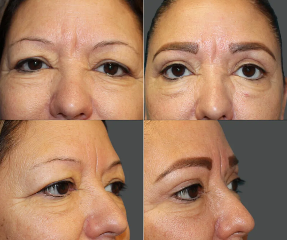 EYELID SURGERY before-and-after result 2