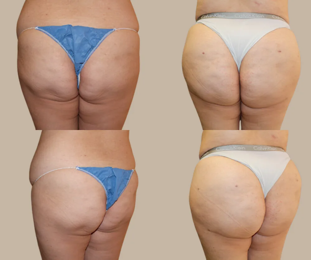 Brazilian Butt Lift Before & After result 4