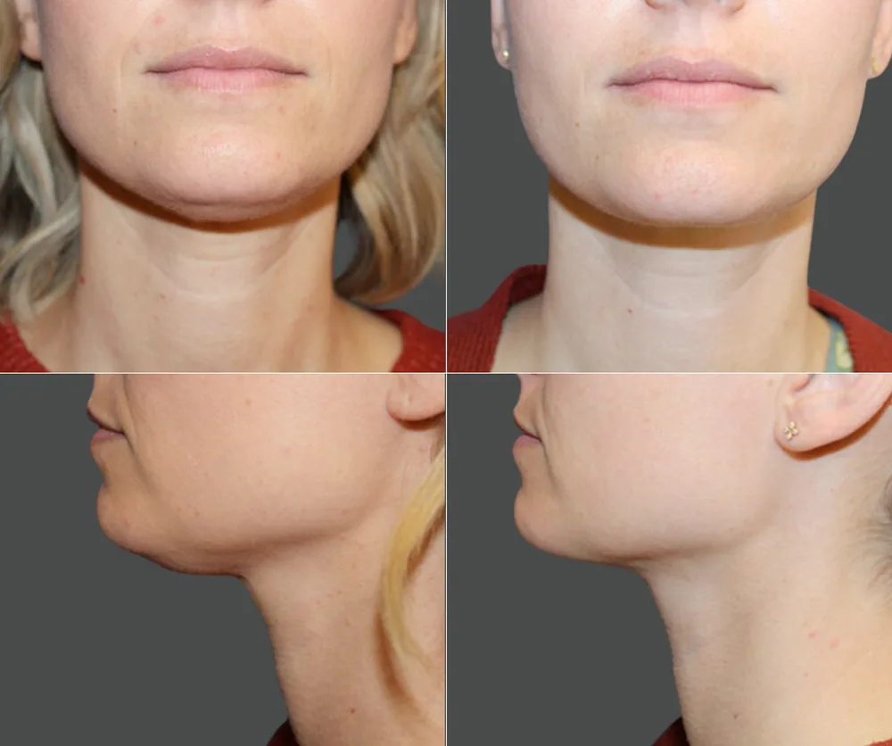 CHIN LIPOSUCTION before-and-after result 3