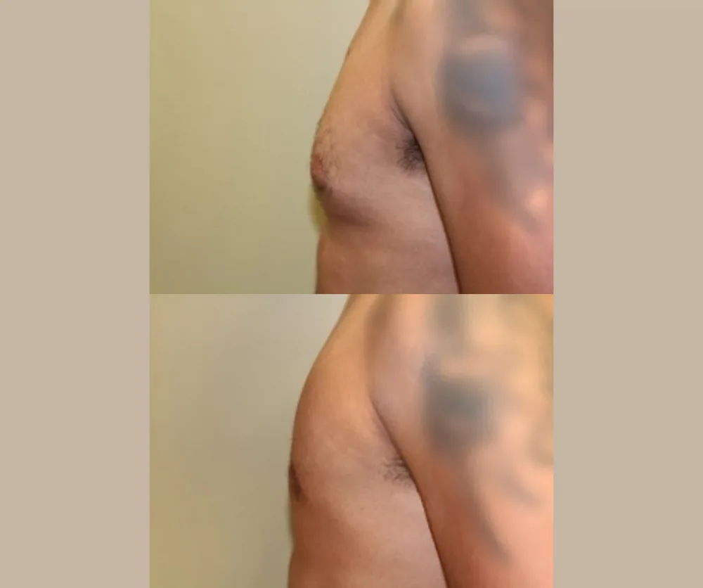 MALE BREAST REDUCTION before-and-after result 2