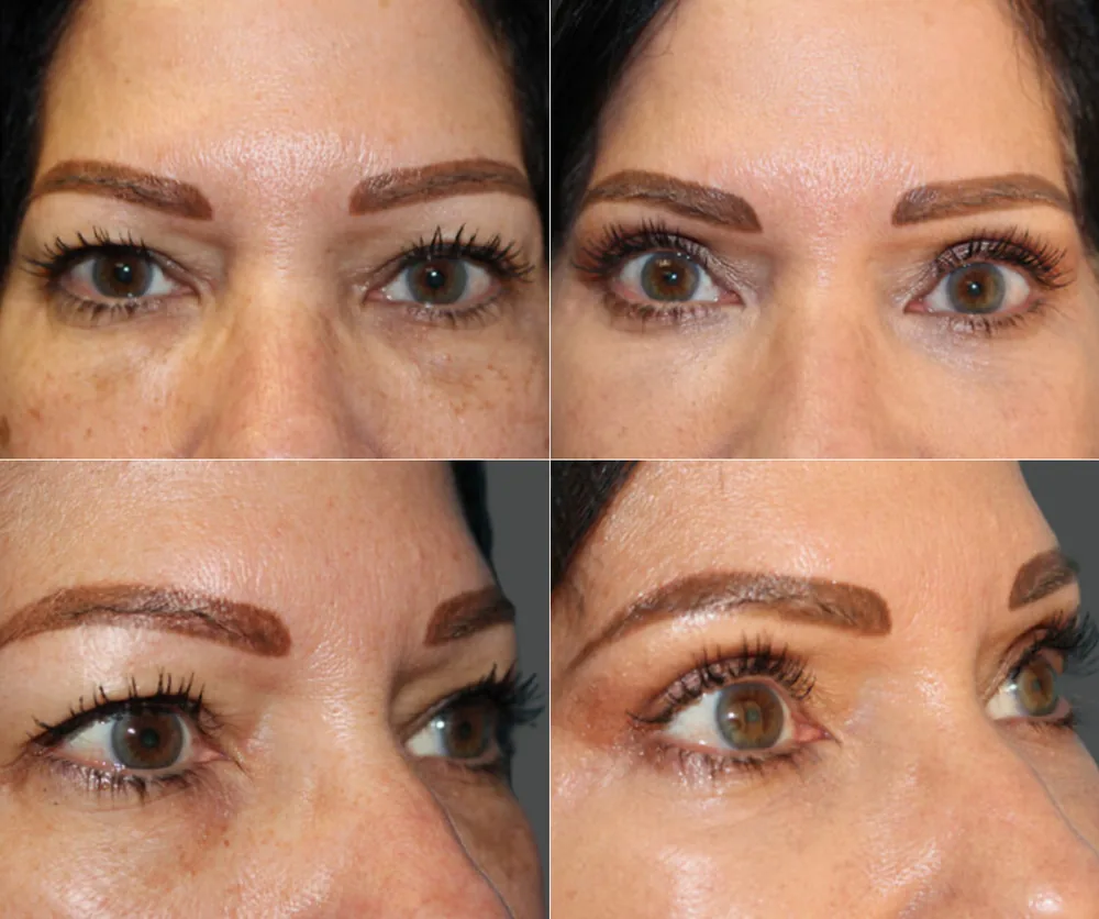 Eyelid Surgery Before & After result 4