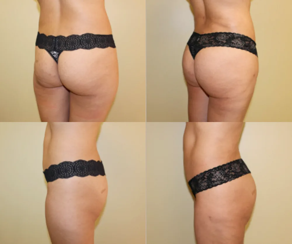 Brazilian Butt Lift before-and-after result 3