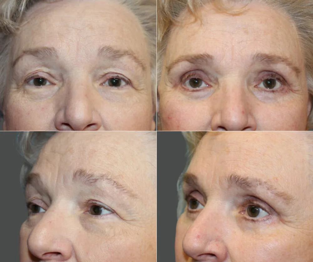 Eyelid Surgery Before & After result 6