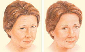 Coronal brow lift technique illustration