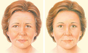 Endoscopic brow lift technique illustration